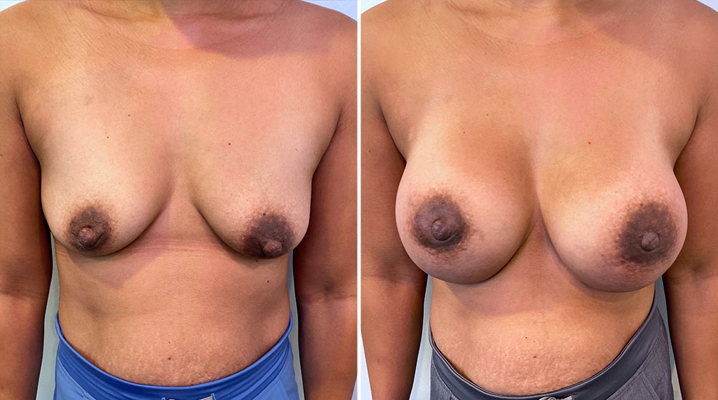 Breast Augmentation