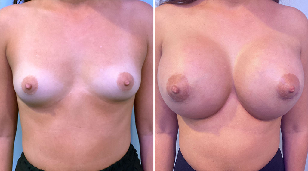 Breast Augmentation