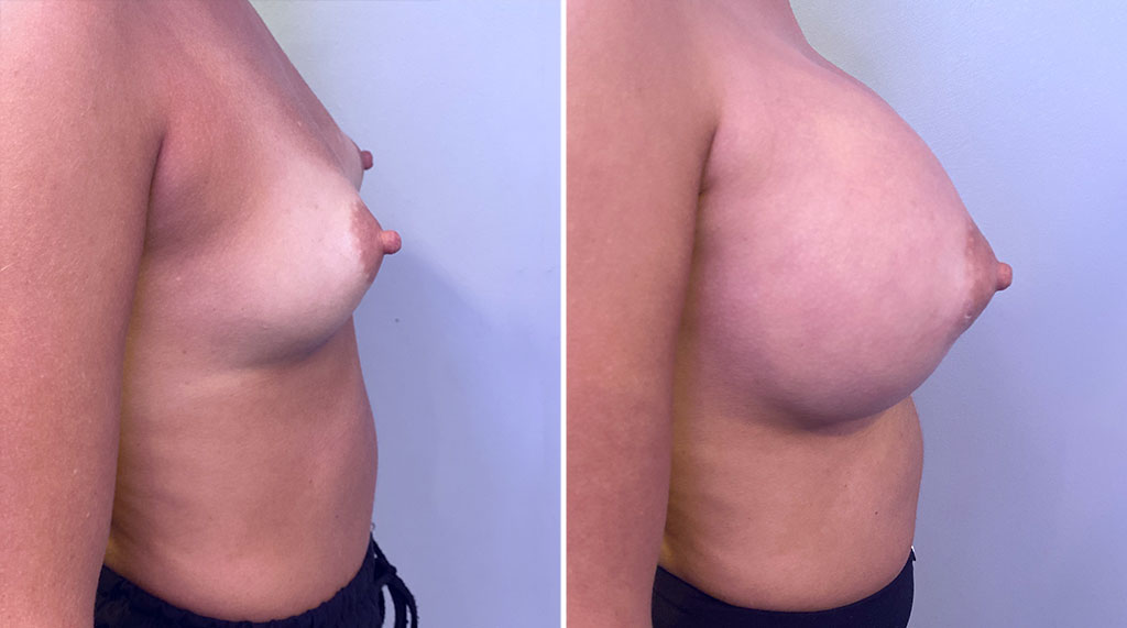 Breast Augmentation