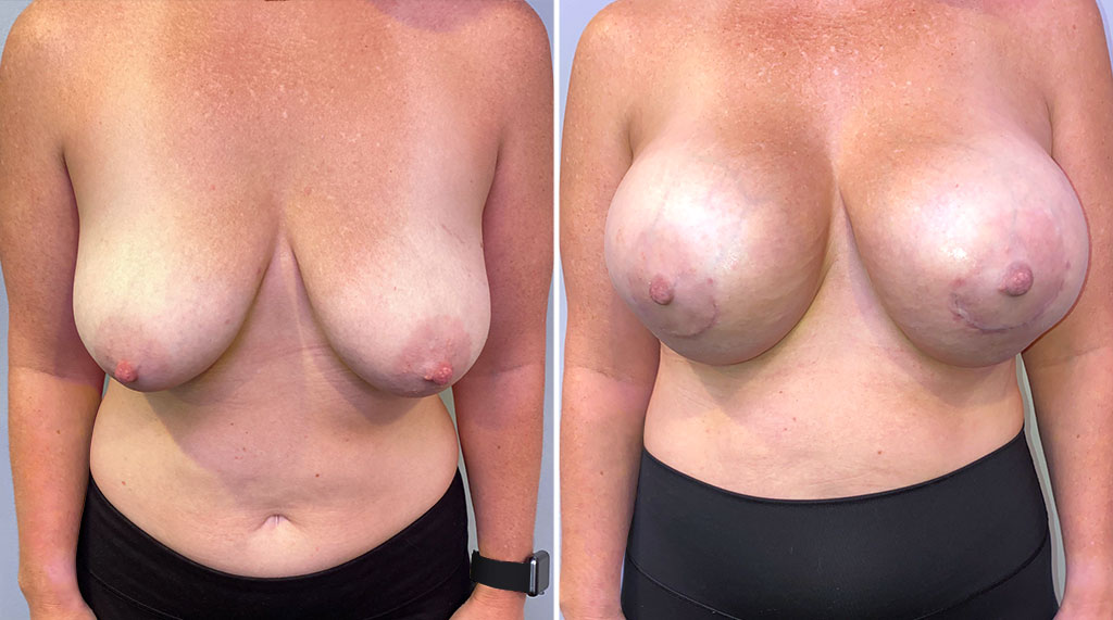 Breast Augmentation