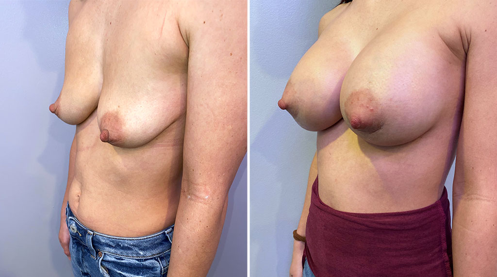 Breast Augmentation