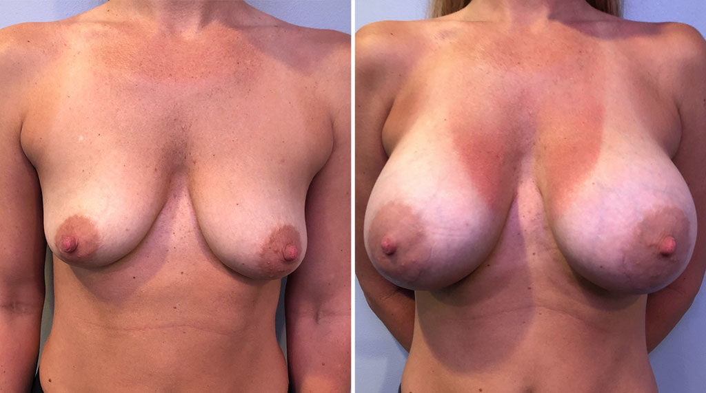 Breast Augmentation