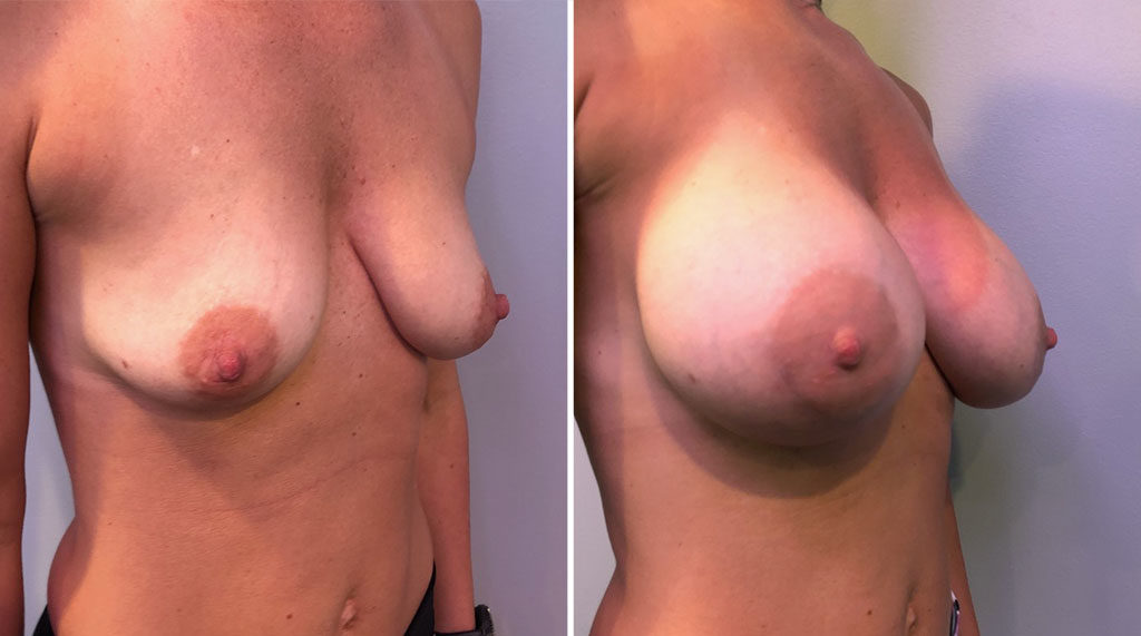 Breast Augmentation