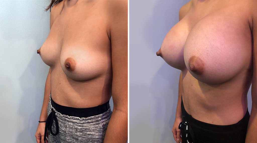 Breast Augmentation