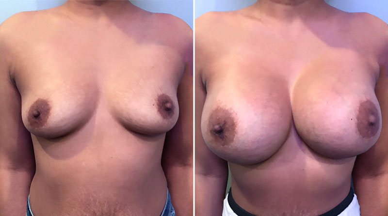 Breast Augmentation