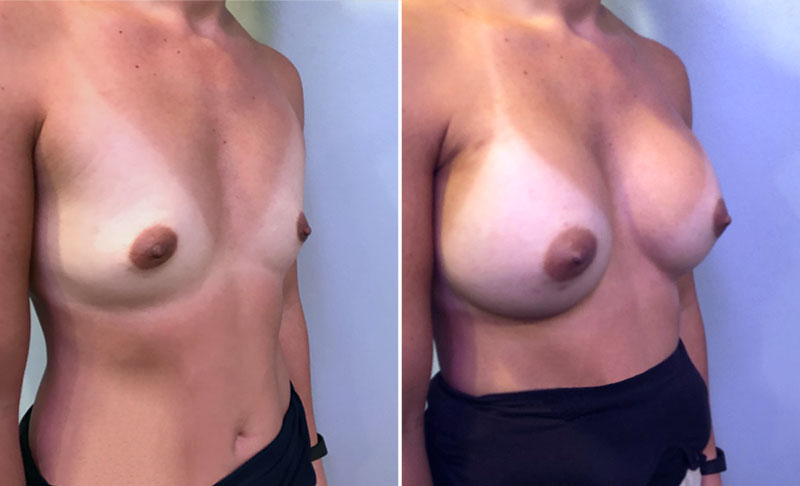 Breast Augmentation