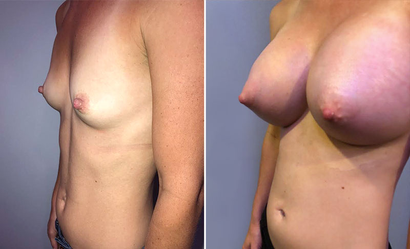 Breast Augmentation