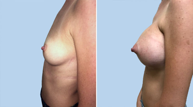 Breast Augmentation