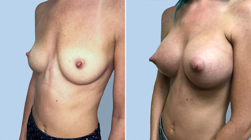 Breast Augmentation