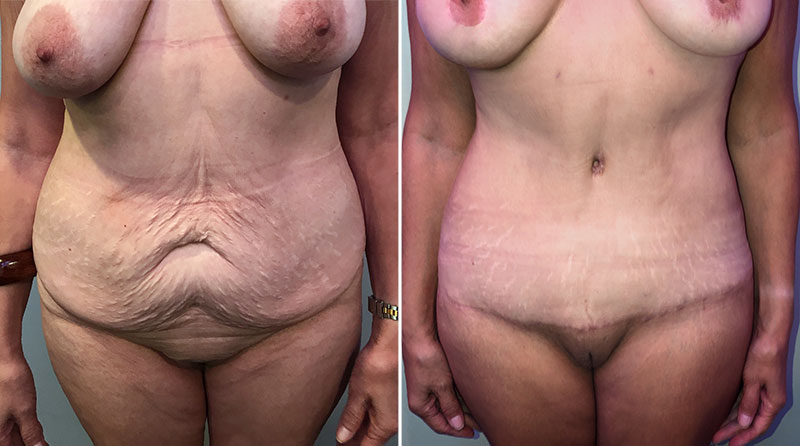 Tummy Tuck