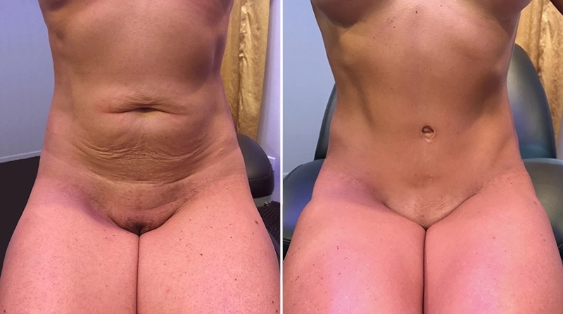 Tummy Tuck