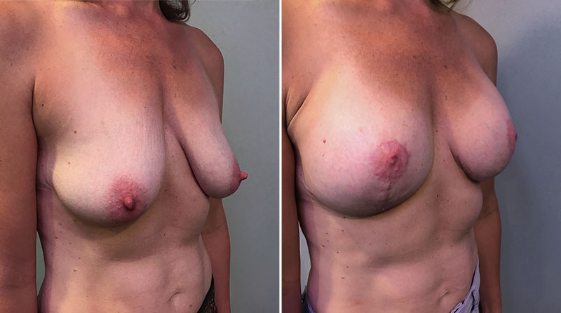 Breast Lift