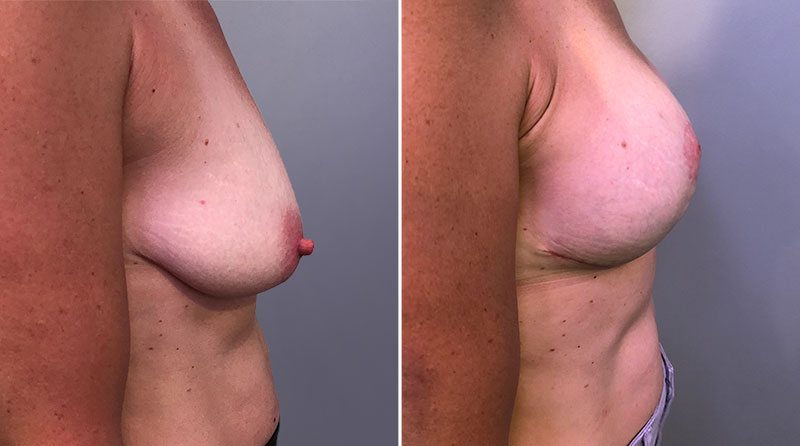 Breast Lift