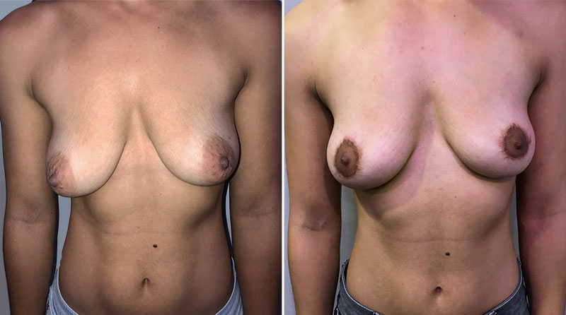 Breast Lift